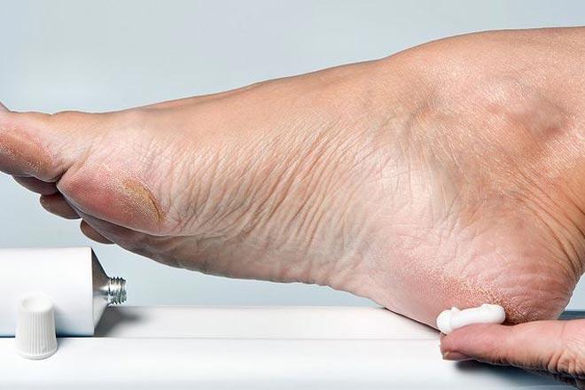 De beste kremene for sprukne hæler ifølge kundeanmeldelser Den beste kremen for sprukne hæler