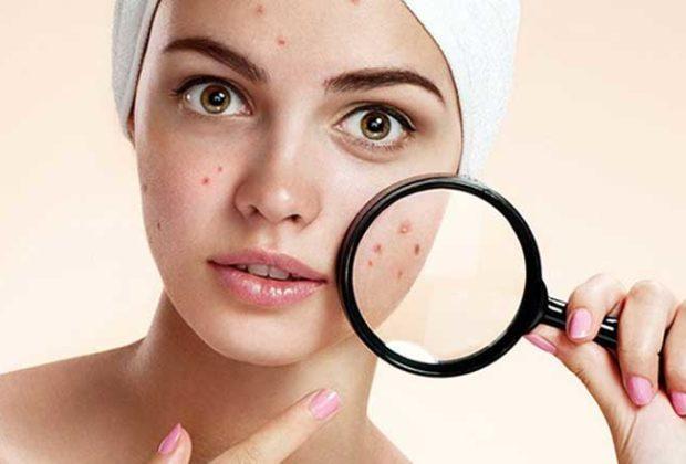 Meilleurs remèdes contre l'acné selon les avis des clients Meilleurs remèdes contre l'acné