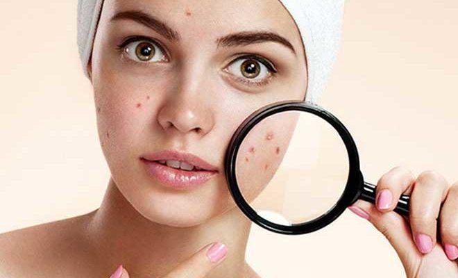 Meilleurs remèdes contre l'acné selon les avis des clients Meilleurs remèdes contre l'acné