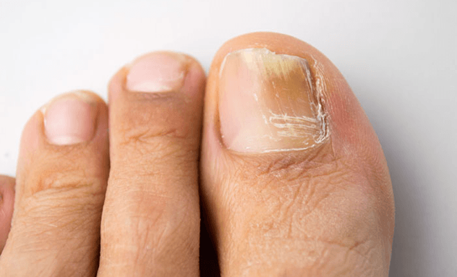 Les meilleurs remèdes contre la mycose des ongles Les meilleurs remèdes contre la mycose des ongles