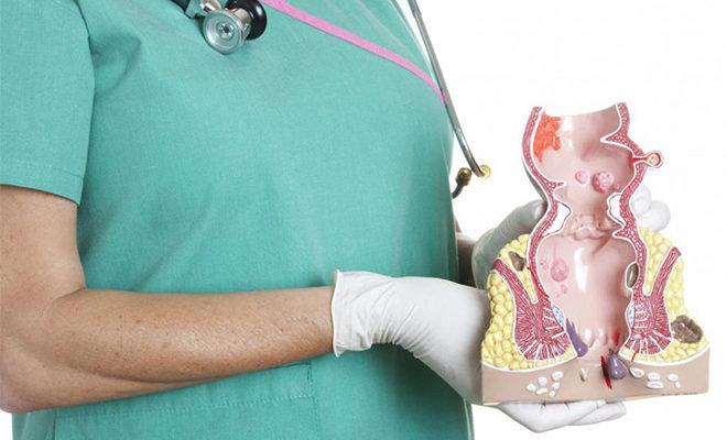 Les meilleurs remèdes contre les hémorroïdes Les meilleurs remèdes contre les hémorroïdes