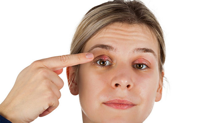 Les meilleurs onguents d'orge Les meilleurs onguents d'orge