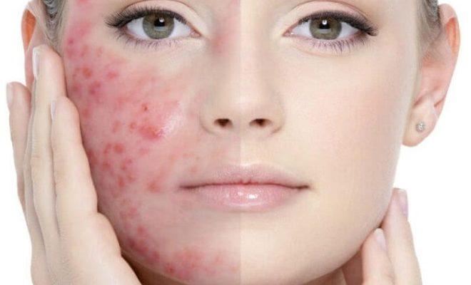 Les meilleures vitamines pour l'acné Les meilleures vitamines pour l'acné