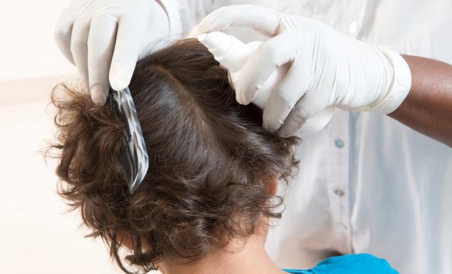 Les meilleurs remèdes contre les poux et les lentes Les meilleurs remèdes contre les poux et les lentes