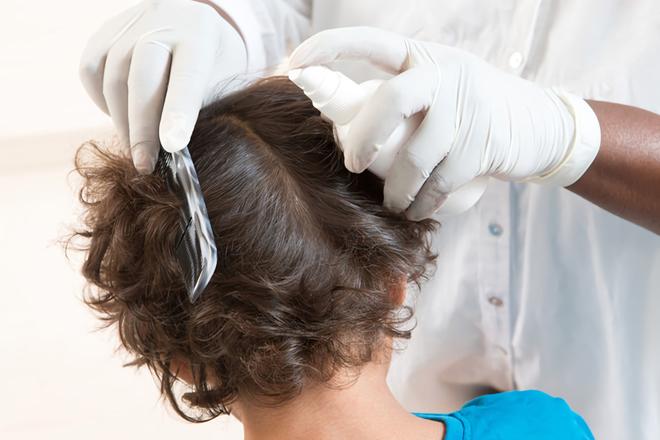 Les meilleurs remèdes contre les poux et les lentes Les meilleurs remèdes contre les poux et les lentes